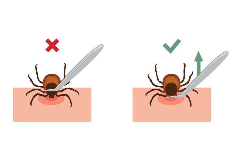 Ilustrație cu modul corect și incorect de îndepărtare a căpușelor cu o pensetă